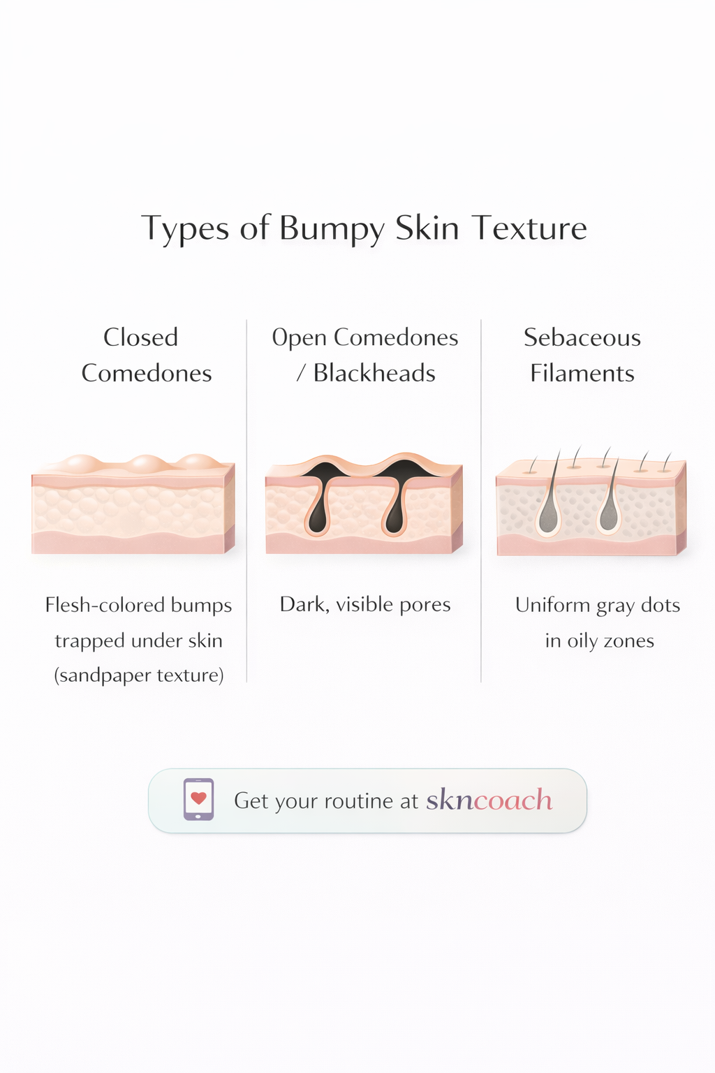Types of closed comedones and how to identify them