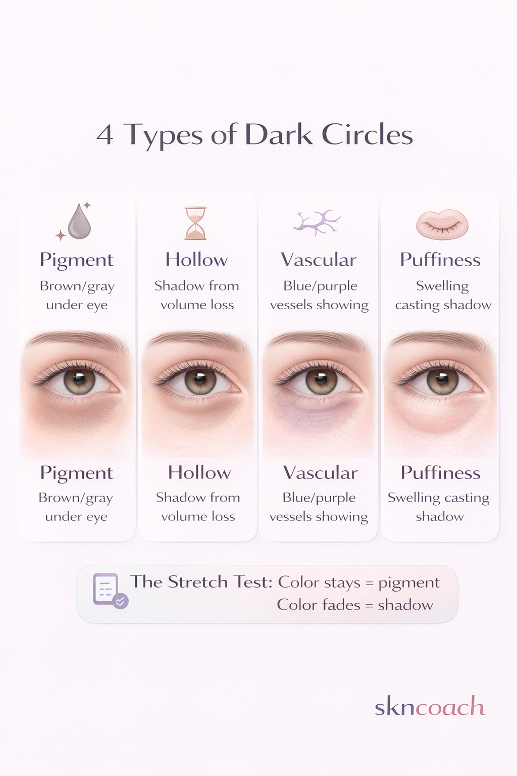 4 types of dark circles - pigment, hollow, vascular, puffiness