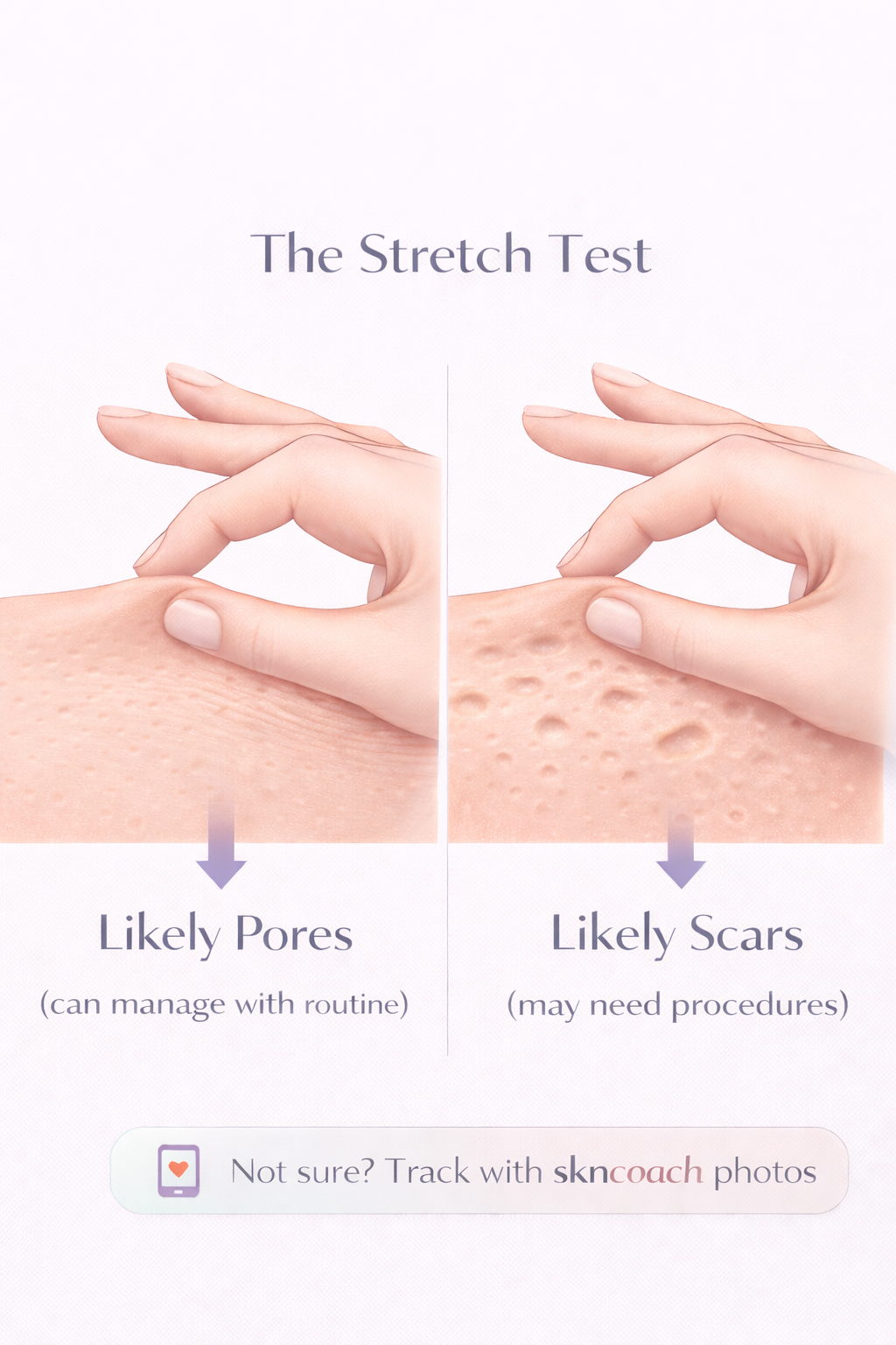 The Stretch Test - how to tell if it's pores or scars
