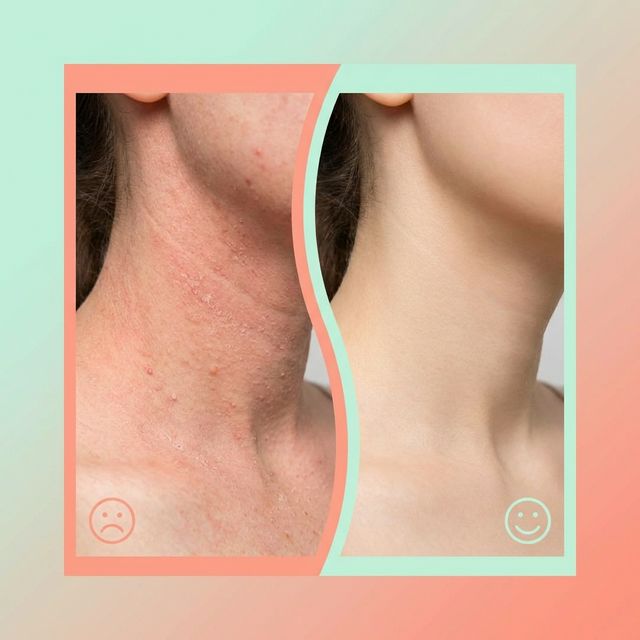 Retinoid Neck Irritation: Why It Happens & How to Fix It